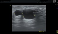 Pat. 36a, septierte Cyste, sogenannte "komplizierte Cyste". gutartig, keine Therapie erforderlich.